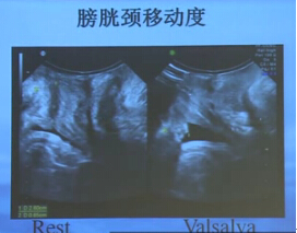 专业园地 研究实践 正文        目前二维盆底超声测量指标残余尿量