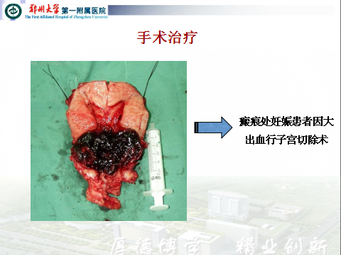 切除瘢痕组织可以看到漂亮的绒毛,腹腔镜监视可以及时发现有无子宫