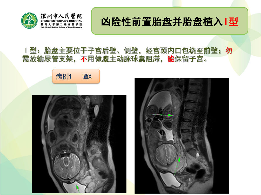 苏放明教授谈:凶险性前置胎盘的诊断分型及分型处理