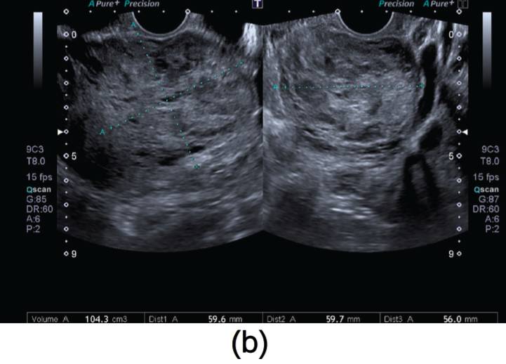 and gynecology 妇产科病例杂志:1例子宫动静脉瘘的成功修复