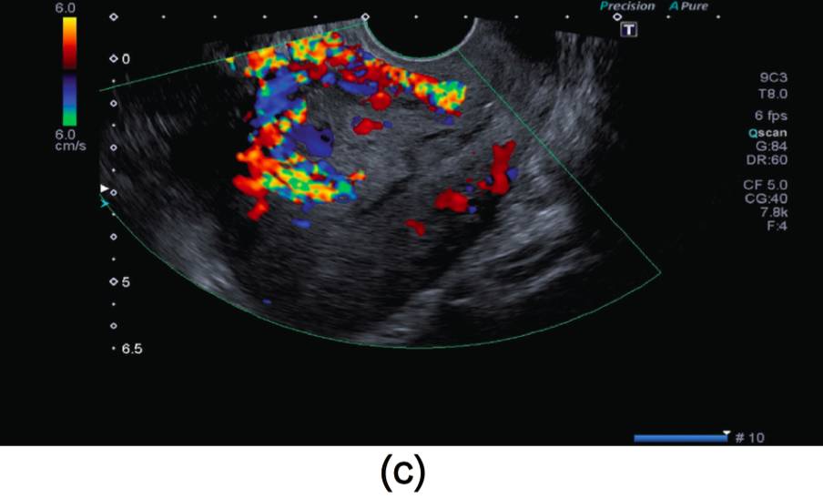 and gynecology 妇产科病例杂志:1例子宫动静脉瘘的成功修复