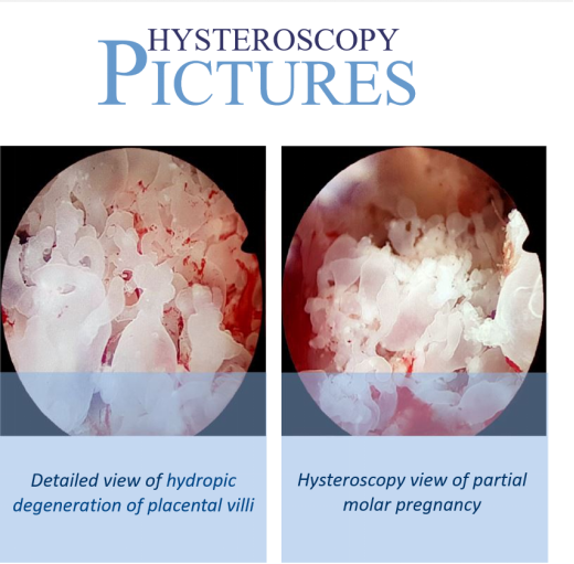 葡萄胎与宫腔镜