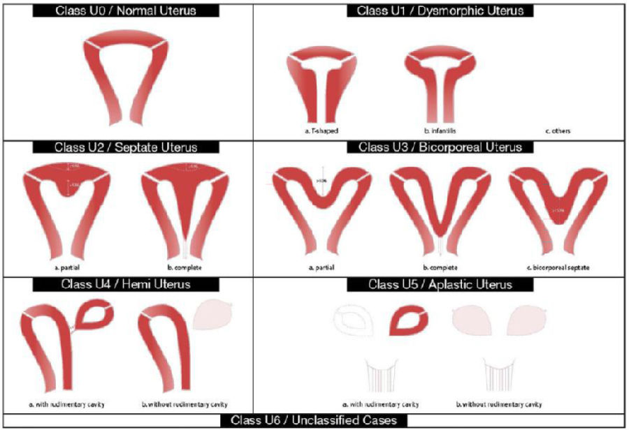病例报告 | T型子宫畸形的微型宫腔镜诊治技巧