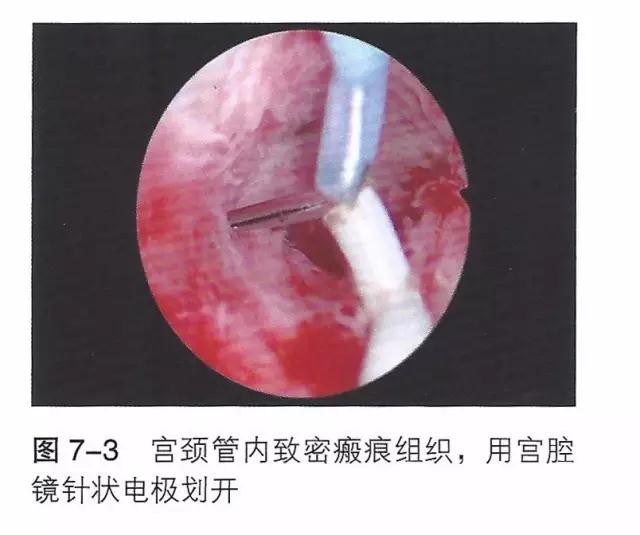 (3)可用宫腔电切镜针状电极划开或环形电极切除宫颈管内致密的粘连