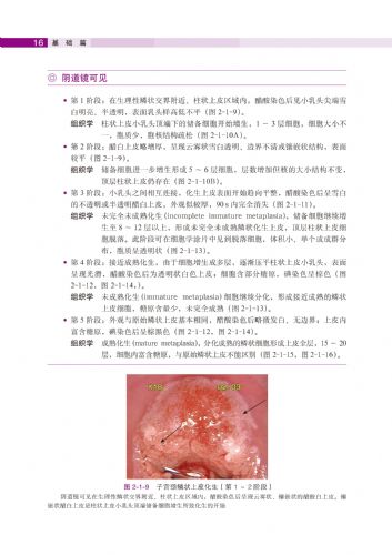 子宫颈转化区特征(2)--《子宫颈疾病——阴道镜图释》