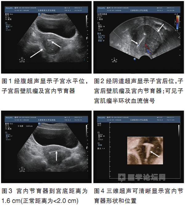 子宫肌瘤超声诊断