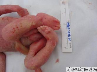 引产照片确诊腭裂本病例中,根据末次月经孕25w6d,通过超声检查发现1.